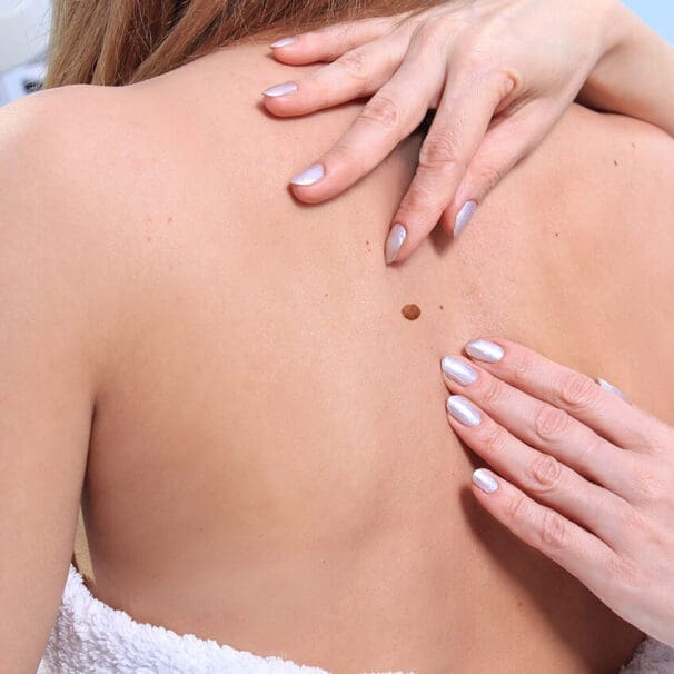 Mohs Surgery